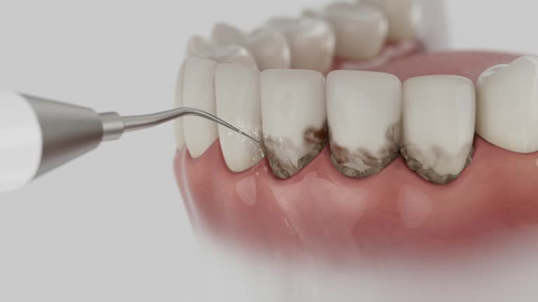 Trusted Wisdom Tooth Removal service in Pine Grove, PA - Dentist Open Now